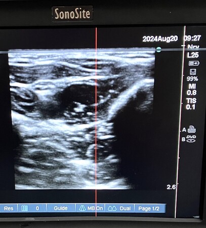 SonoSite L25x Linear Array Probe